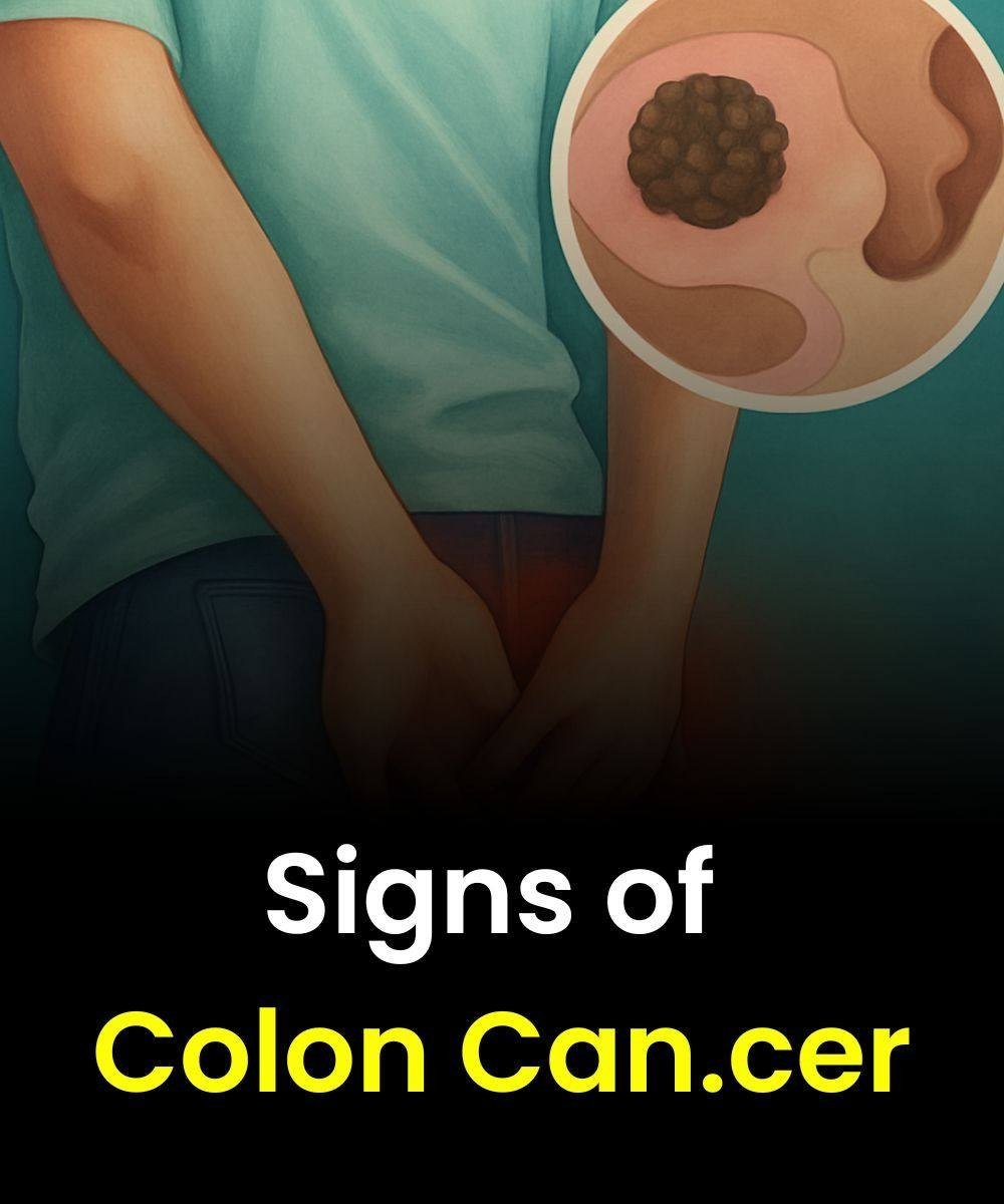 Signs of Colon Cancer